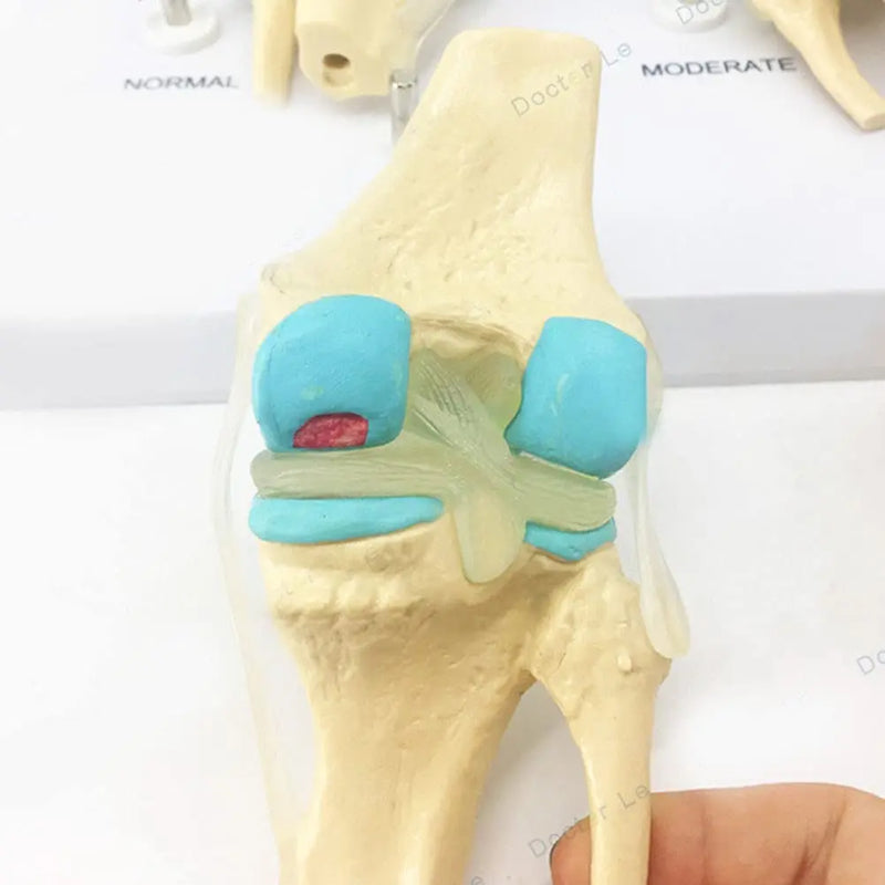 Four-stage Human Pathological Knee Joint Anatomy Model Medical Science Teaching Resources