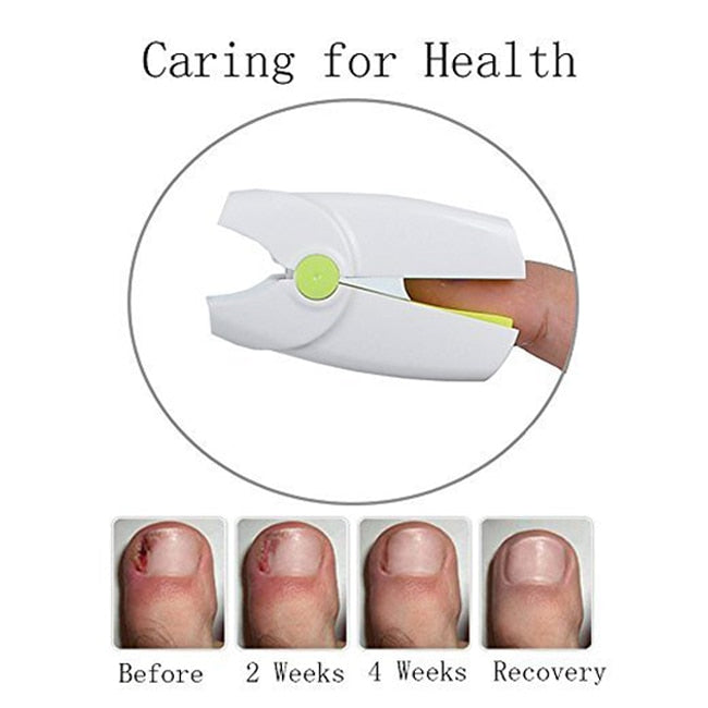 Highly Effective Rechargeable Nail Fungus Laser Device Nail Infection Onychomycosis Cure Nail Fungal Infections