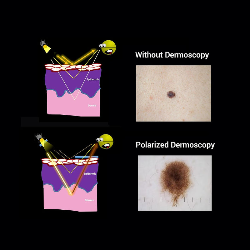 Dermatoskop IBOOLO DE-3100, powiększanie 10x, analizator skóry, spolaryzowany dermatoskop