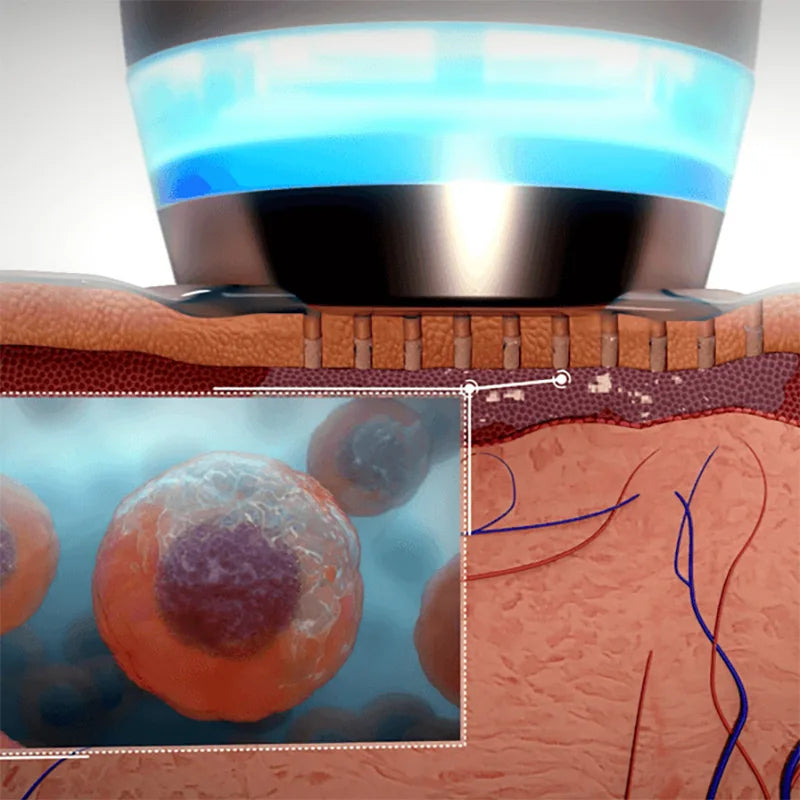 קוריאה אפולו מכשיר לטיפול בעור טכנולוגיית RF רב קוטבית בשילוב עם אלקטרופורציה ואינטופורזה