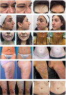 المحمولة 2 في 1 Morpheus8 آلة رفع الجلد مكافحة الشيخوخة النمش إزالة التجاعيد علاج حب الشباب كسور صالون استخدام جهاز