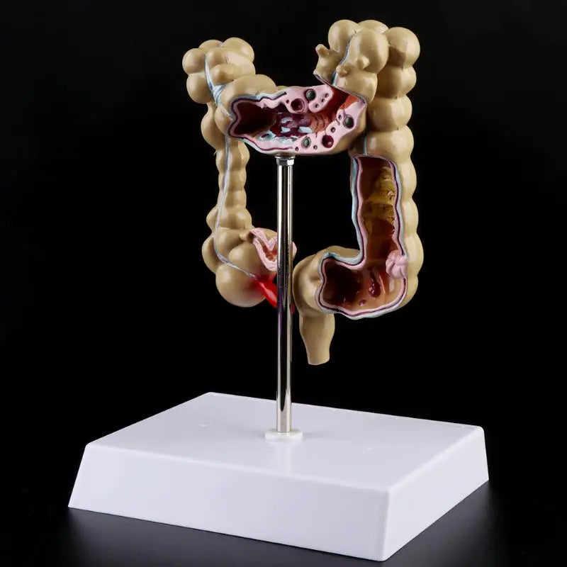 Human Colorectal Lesion Model Pathological Anatomy Colon Diseases ...