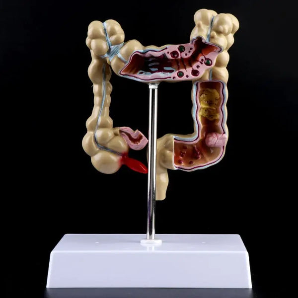 Model uszkodzenia jelita grubego człowieka Anatomia patologiczna Choroby okrężnicy Jelito Narzędzie do nauczania medycznego