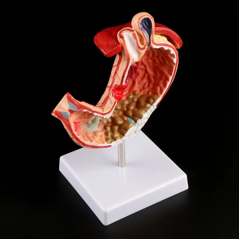 Anatomia anatômica humana estômago modelo médico patologia gástrica gastrite úlcera ferramenta de aprendizagem de ensino médico