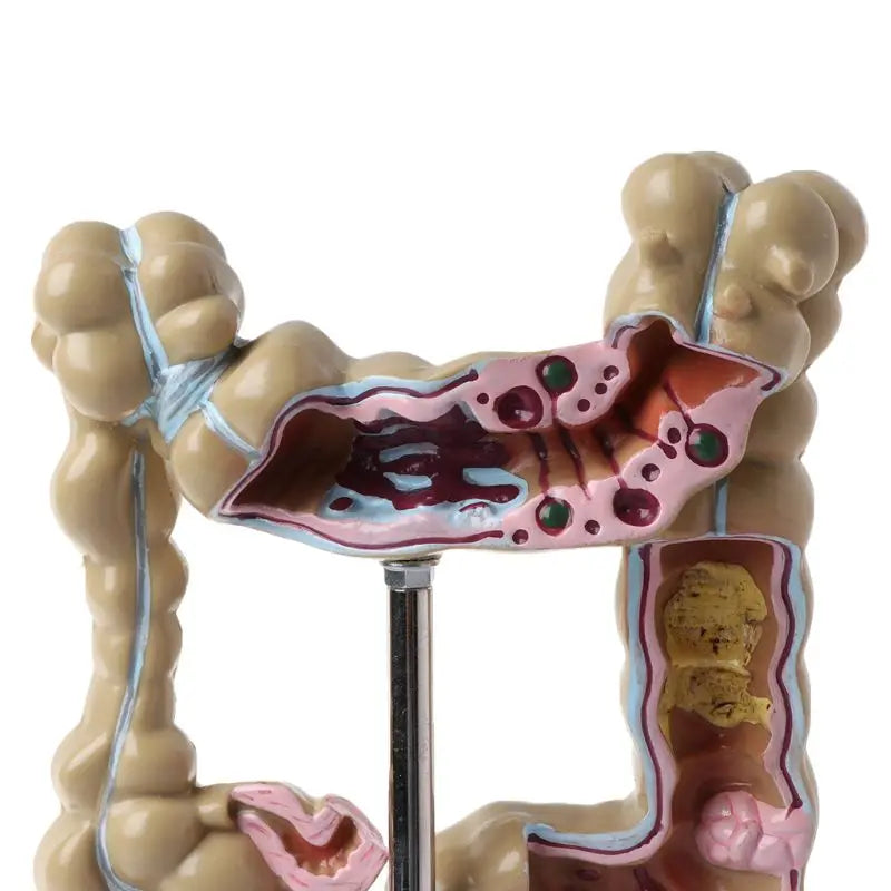 Human Colorectal Lesion Model Pathological Anatomy Colon Diseases ...