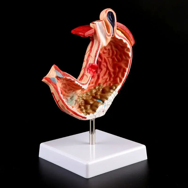Anatomia człowieka Model medyczny żołądka Patologia żołądka Zapalenie żołądka Wrzód Medyczne narzędzie do nauczania