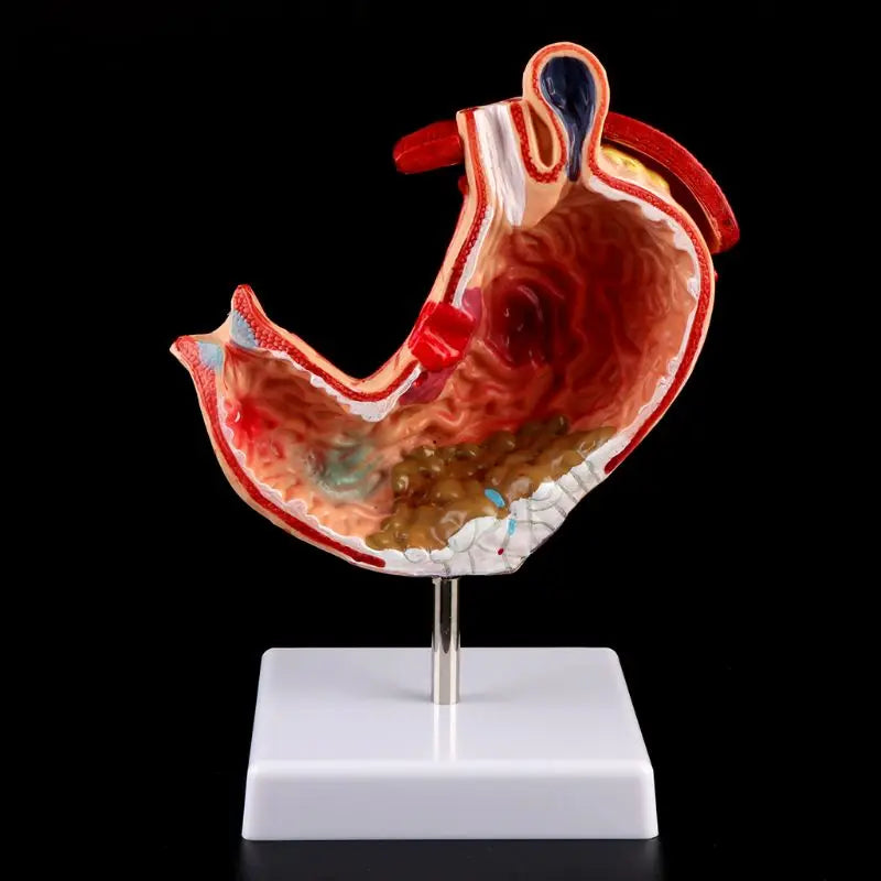 Anatomia anatomica umana Stomaco Modello medico Patologia gastrica Gastrite Ulcera Strumento di apprendimento per l'insegnamento medico