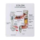 Human Colorectal Lesion Model Pathological Anatomy Colon Diseases Intestine Medical Teaching Learning Tool