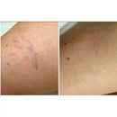 Große Power 60w RF Rote Blutgefäße Gefäß Entfernung Schönheit Ausrüstung Hohe Frequenz Nadel RF Spinne Venen Entfernung Gerät