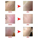 Große Power 60w RF Rote Blutgefäße Gefäß Entfernung Schönheit Ausrüstung Hohe Frequenz Nadel RF Spinne Venen Entfernung Gerät