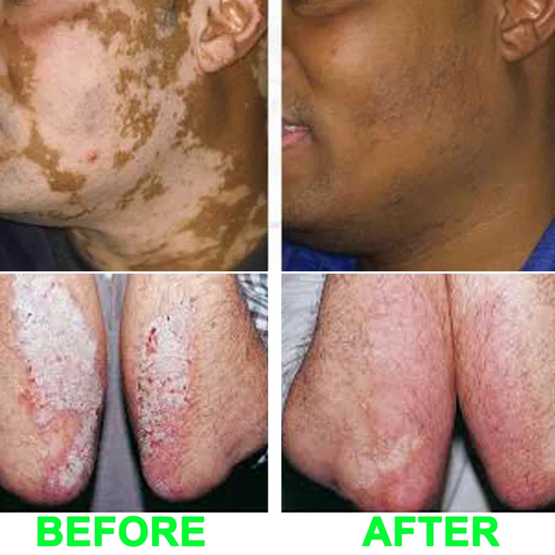 SIGMA SH4B Dermatologie Lichttherapie 311nm UVB Fototherapie-eenheid voor Vitiligo Psoriasis Eczeem