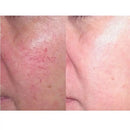 Große Power 60w RF Rote Blutgefäße Gefäß Entfernung Schönheit Ausrüstung Hohe Frequenz Nadel RF Spinne Venen Entfernung Gerät