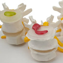 Modello anatomico patologico della colonna lombare umana in 4 fasi Risorse didattiche per scienze mediche