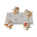 Modello anatomico patologico della colonna lombare umana in 4 fasi Risorse didattiche per scienze mediche