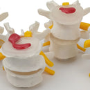 Modello anatomico patologico della colonna lombare umana in 4 fasi Risorse didattiche per scienze mediche