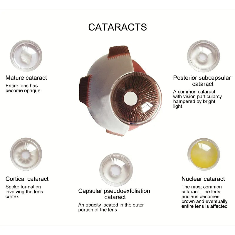 Modelo de enseñanza de anatomía de catarata de ojo humano de PVC 4X