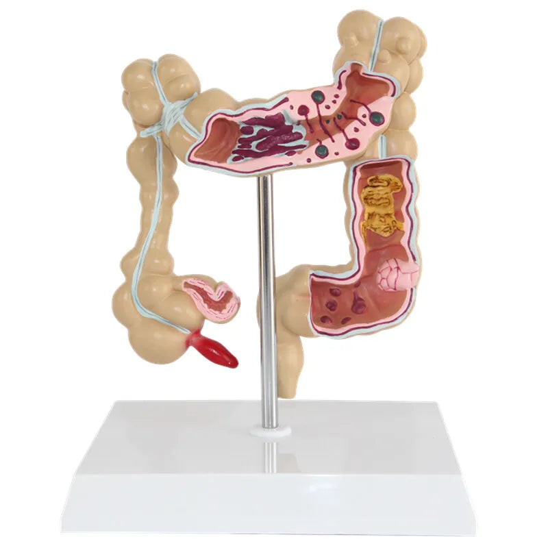 Modelo anatômico de lesão colorretal humana, anatomia, doenças do cólon, intestino, ensino de medicina, ferramenta de aprendizagem
