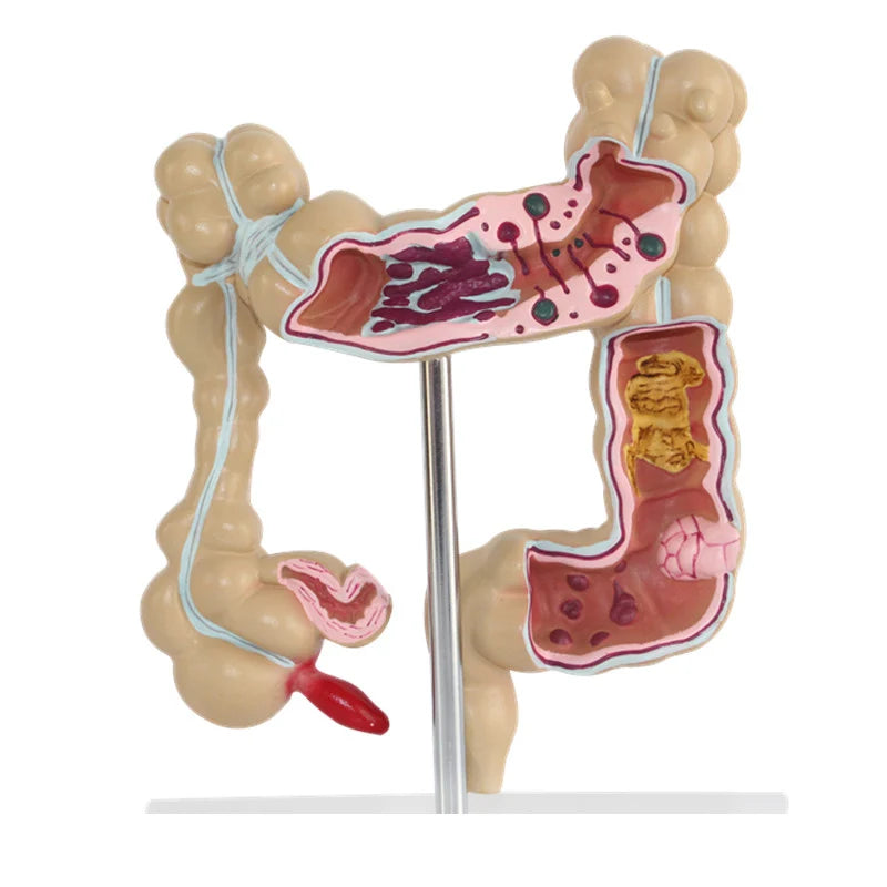 Modelo anatômico de lesão colorretal humana, anatomia, doenças do cólon, intestino, ensino de medicina, ferramenta de aprendizagem
