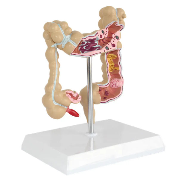 Anatomik İnsan Kolorektal Lezyon Modeli Anatomisi Kolon Hastalıkları Bağırsak Tıbbi Öğretim Öğrenme Malzemeleri Aracı