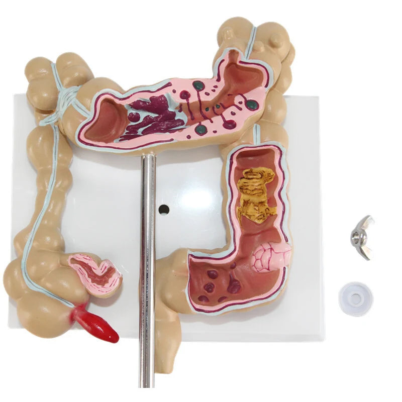 Modelo anatómico de lesión colorrectal humana, herramienta de suministros de aprendizaje para enseñanza médica, enfermedades del Colon, anatomía