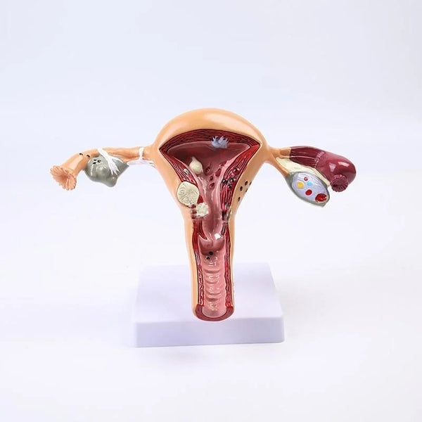 Modèle anatomique pathologique de l'utérus et de l'ovaire, modèle d'organe médical, outil d'étude en coupe transversale
