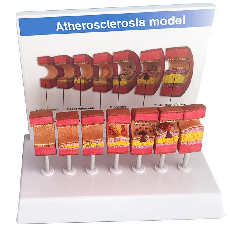 Arterial Vessel Atherosclerosis Model Middle-Aged And Elderly Blood Vessel Structure Model