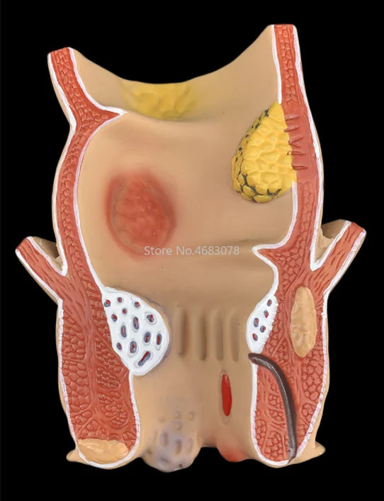 Brand New Anatomical Human Rectum Pathology Lesion Model Hemorrhoids Anus Medical Teaching Supplies