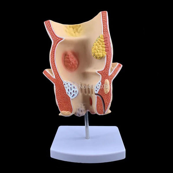 Nuovissimo modello anatomico di patologia del retto umano, modello di lesione, emorroidi, ano, materiale didattico medico