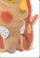 מותג חדש אנטומי אנושי פתולוגיה פי הטבעת מודל נגע טחורים פי הטבעת ציוד הוראה רפואי