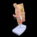 מותג חדש אנטומי אנושי פתולוגיה פי הטבעת מודל נגע טחורים פי הטבעת ציוד הוראה רפואי