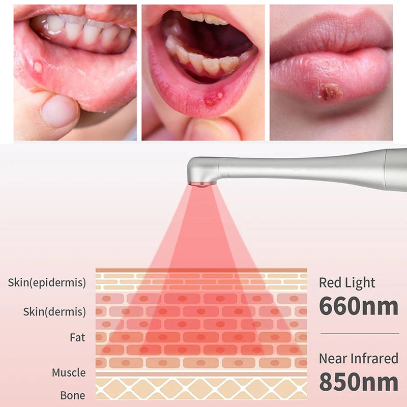 Cold Sore Laser Therapy Device Light Therapy Mouth Ulceration Blisters Herpes Infection Pain Relief Ulcer Medical Laser Care2023
