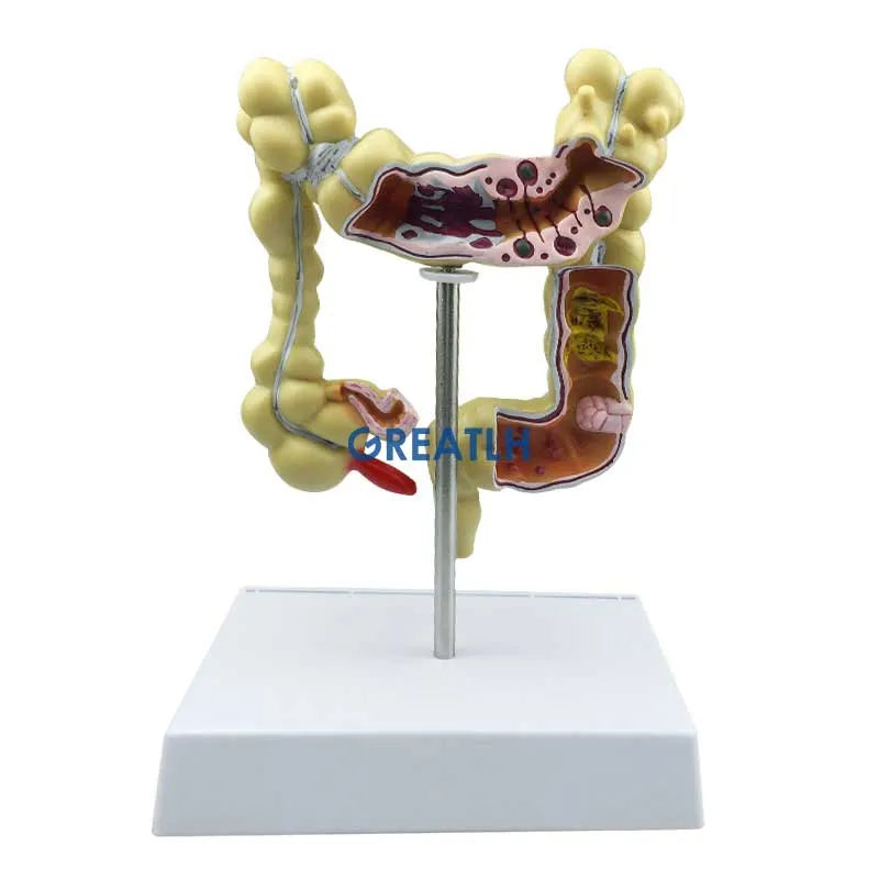 Modelo de lesión colorrectal, serpiente de Colon humano, modelo de enfermedades patológicas del intestino grueso, organizador médico de anatomía