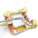 דגם נגע מעי גס אנושי נחש מעי גס מחלות פתולוגיות דגם ארגונית רפואית אנטומיה