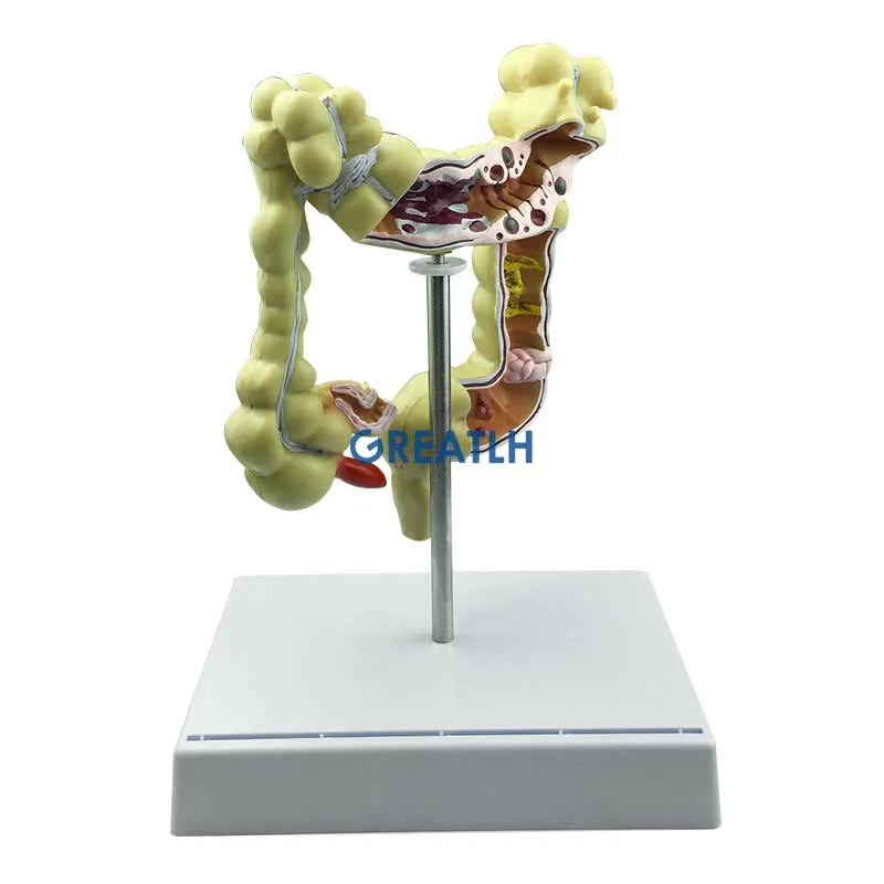 Colorectal Lesion Model Human Colon Snake Large Intestine Pathological ...