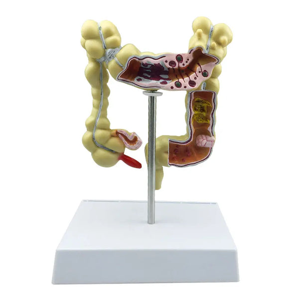 Modelo de lesão colorretal, cobra de cólon humano, doenças patológicas do intestino grosso, modelo organizador médico, anatomia
