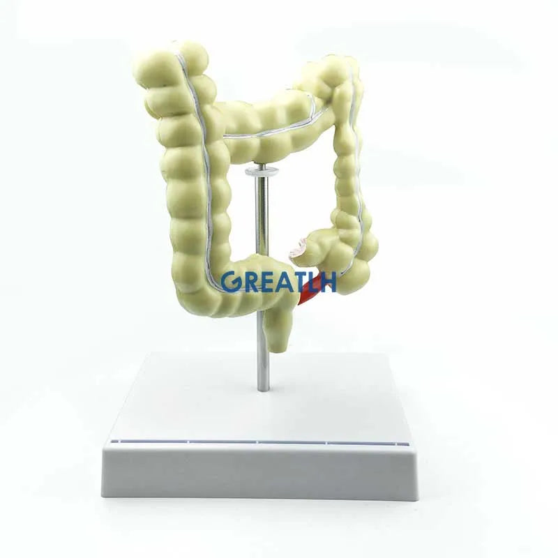 Colorectal Lesion Model Human Colon Snake Large Intestine Pathological ...