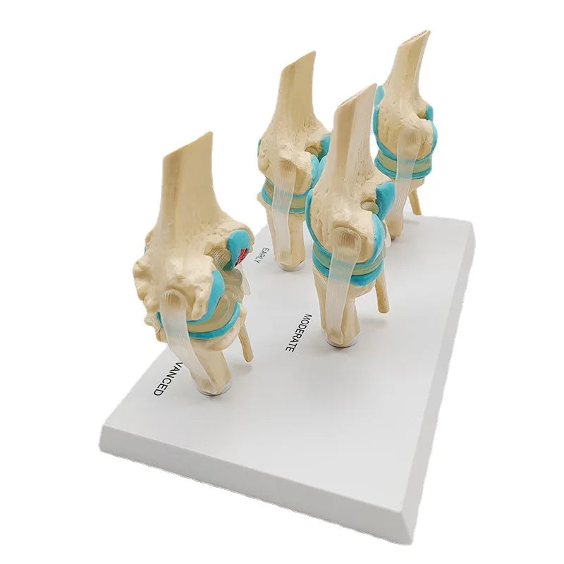 Modello di anatomia patologica dell'articolazione del ginocchio umano in quattro fasi Risorse didattiche per scienze mediche