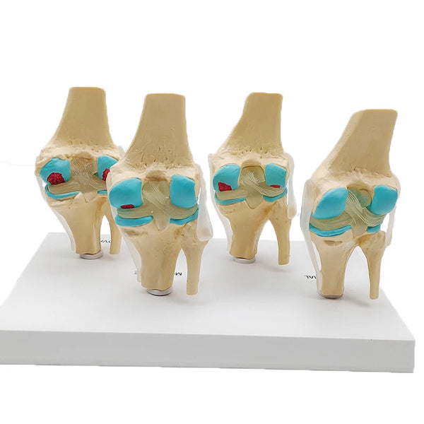 Modelo de anatomia patológica humana de quatro estágios da articulação do joelho, recursos de ensino de ciências médicas