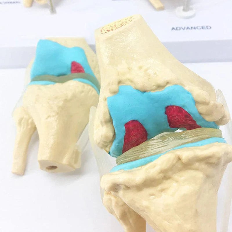 4단계 인간 병리학적 무릎 관절 해부학 모델 의학 과학 교육 자료