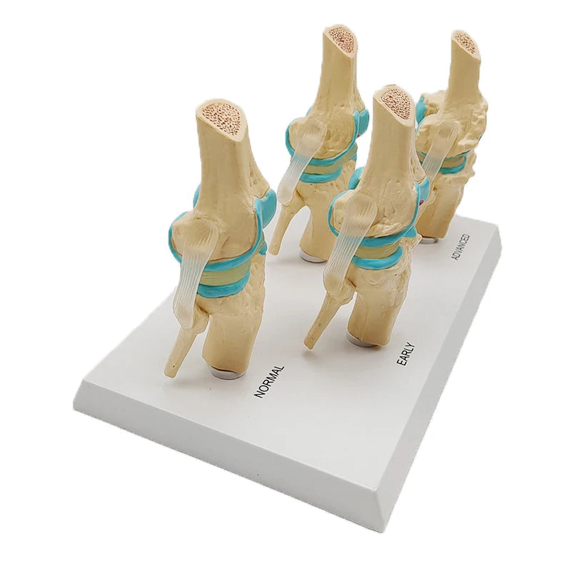 Modello di anatomia patologica dell'articolazione del ginocchio umano in quattro fasi Risorse didattiche per scienze mediche