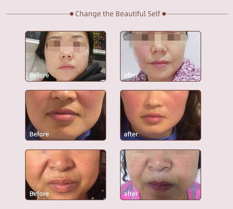 5 in 1 Quantum Hydro-Optical Facial Beauty Apparatus Skin RF Lifting EMS Mesotherapy Skin Rejuvenation Vacuum Hydration