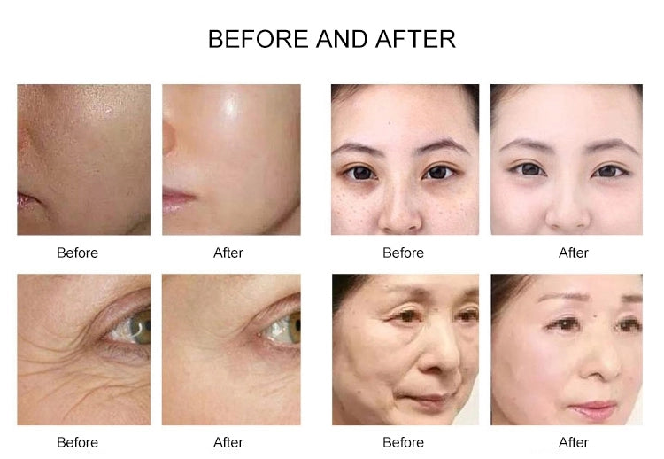 Mesotherapy Gun
