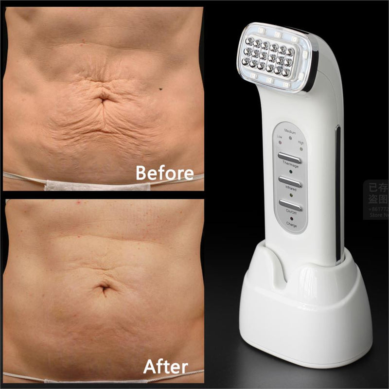 Real Rimuovi rughe Dot Matrix Facciale Termaggio Radio Frequenza Sollevamento viso Ascensore Body Body Skin Care Device Beauty 110-240V