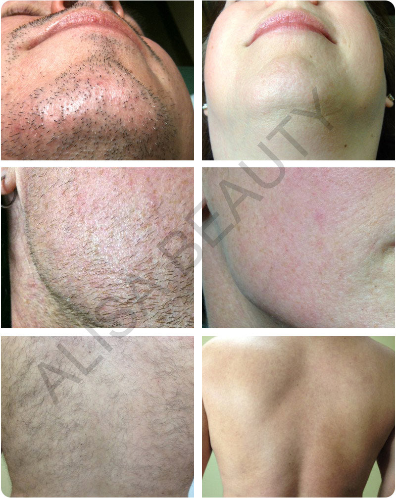 DEESS GP586 Permanente Laser Epilator IPL Ontharing Ontharingscrème Full Body Gebruik Verwijder Acne en rimpel Bikini Gezicht Ontharing