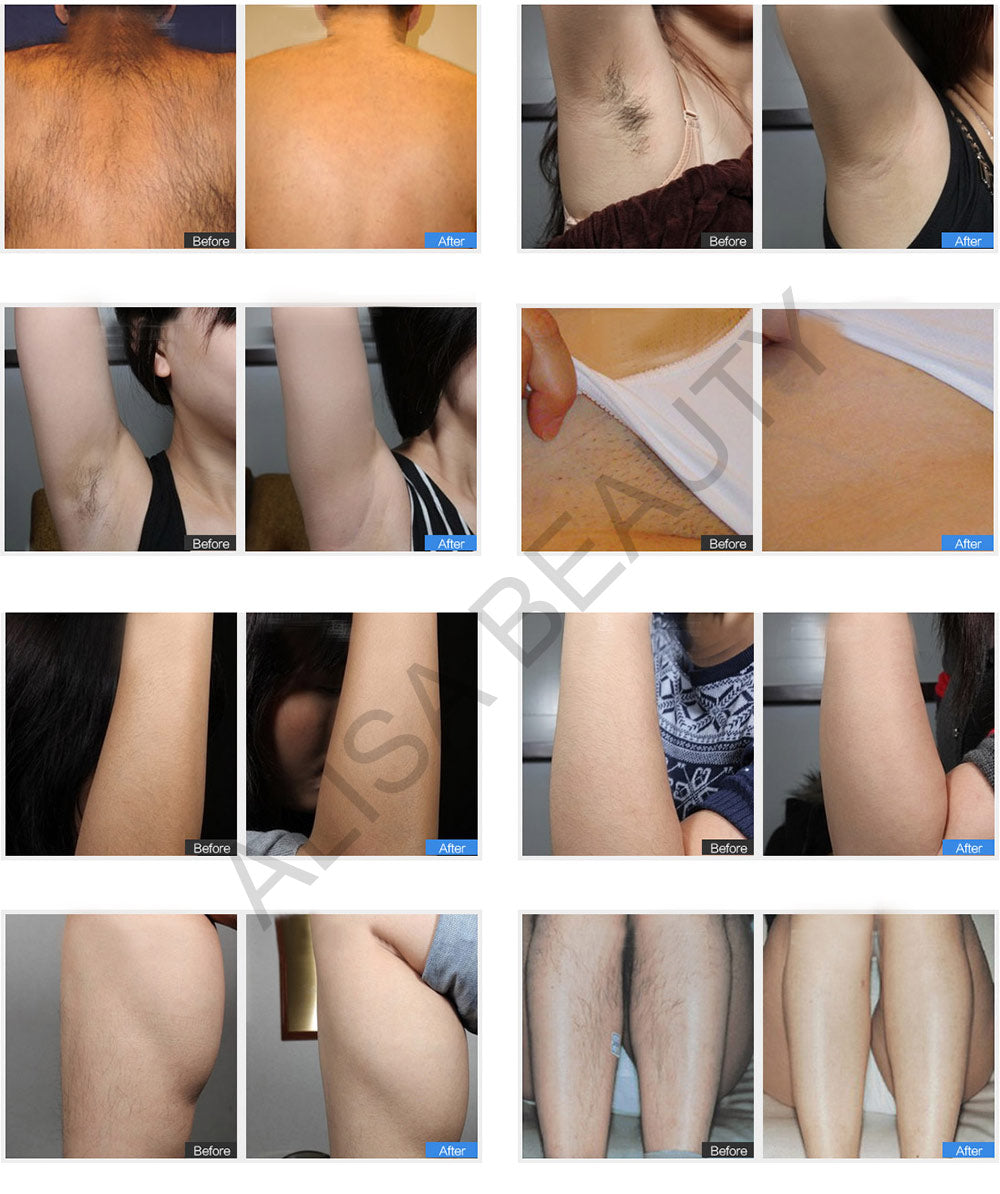 DEESS GP586 Permanente Laser Epilator IPL Ontharing Ontharingscrème Full Body Gebruik Verwijder Acne en rimpel Bikini Gezicht Ontharing