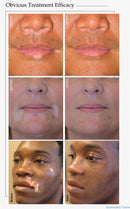 Phototherapie für zu Hause, 308 nm LED-UVB-Lichttherapiestab für Spot-Vitiligo-Psoriasis-Behandlungsgerät