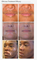 Fototerapi di rumah Tongkat Terapi Cahaya UVB LED 308nm untuk Mesin Rawatan Psoriasis Spot Vitiligo