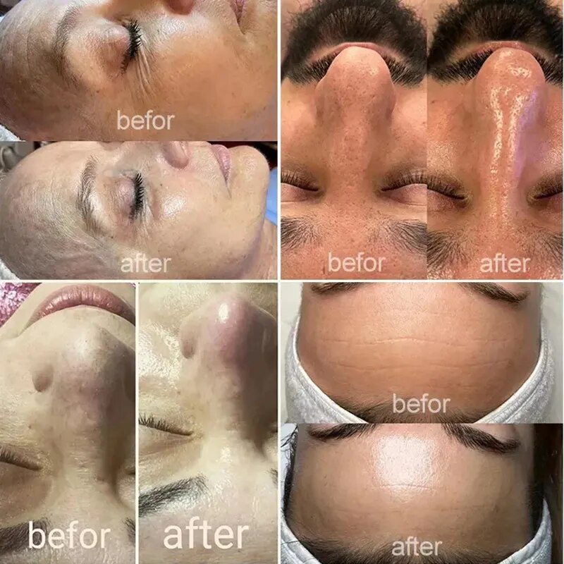 Hydrafacial Moisturizing Facial Hud Care Diamond Skin Machine Spray Fuktgivande rengöring Anti-aging ansiktshud Machine