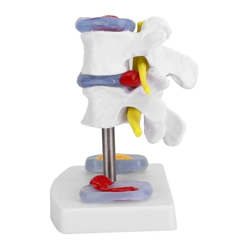 Intervertebral Disc Herniation Bone Pathology Model Lumbar Spine Bone Medicine Teaching Model Medicine Teaching