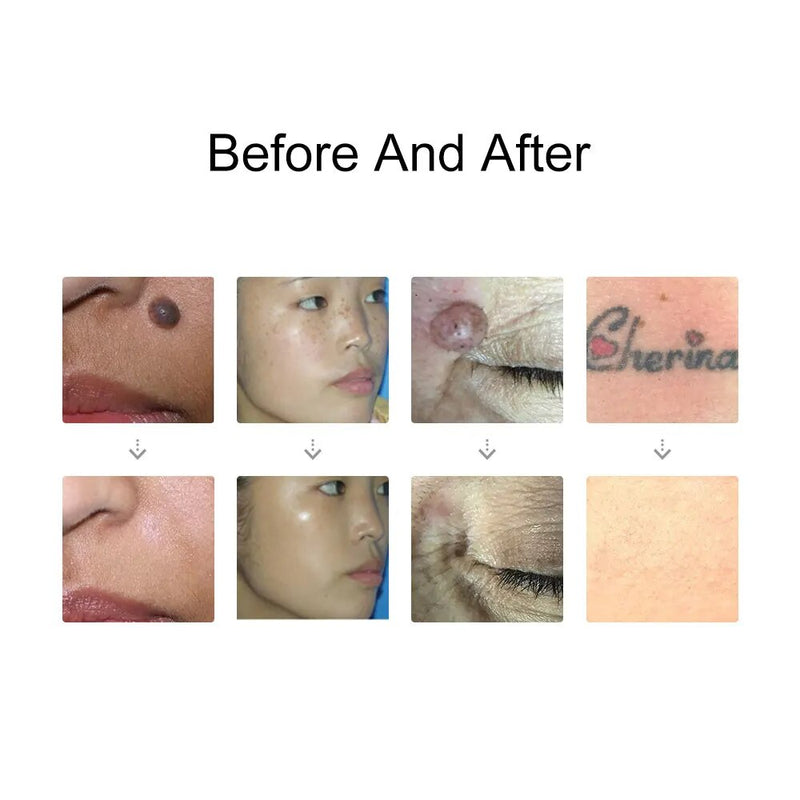 Laser picosegundo caneta sarda remoção de tatuagem visando alvo localizar posição mole mancha sobrancelha pigmento removedor acne cuidados beleza